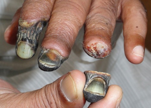krokodil_drug_02